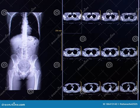 Contact information for osiekmaly.pl - Multilevel degenerative disc disease is a condition characterized by the degeneration of intervertebral discs, impacting osseous structures and leading to changes in the spine. The degeneration …
